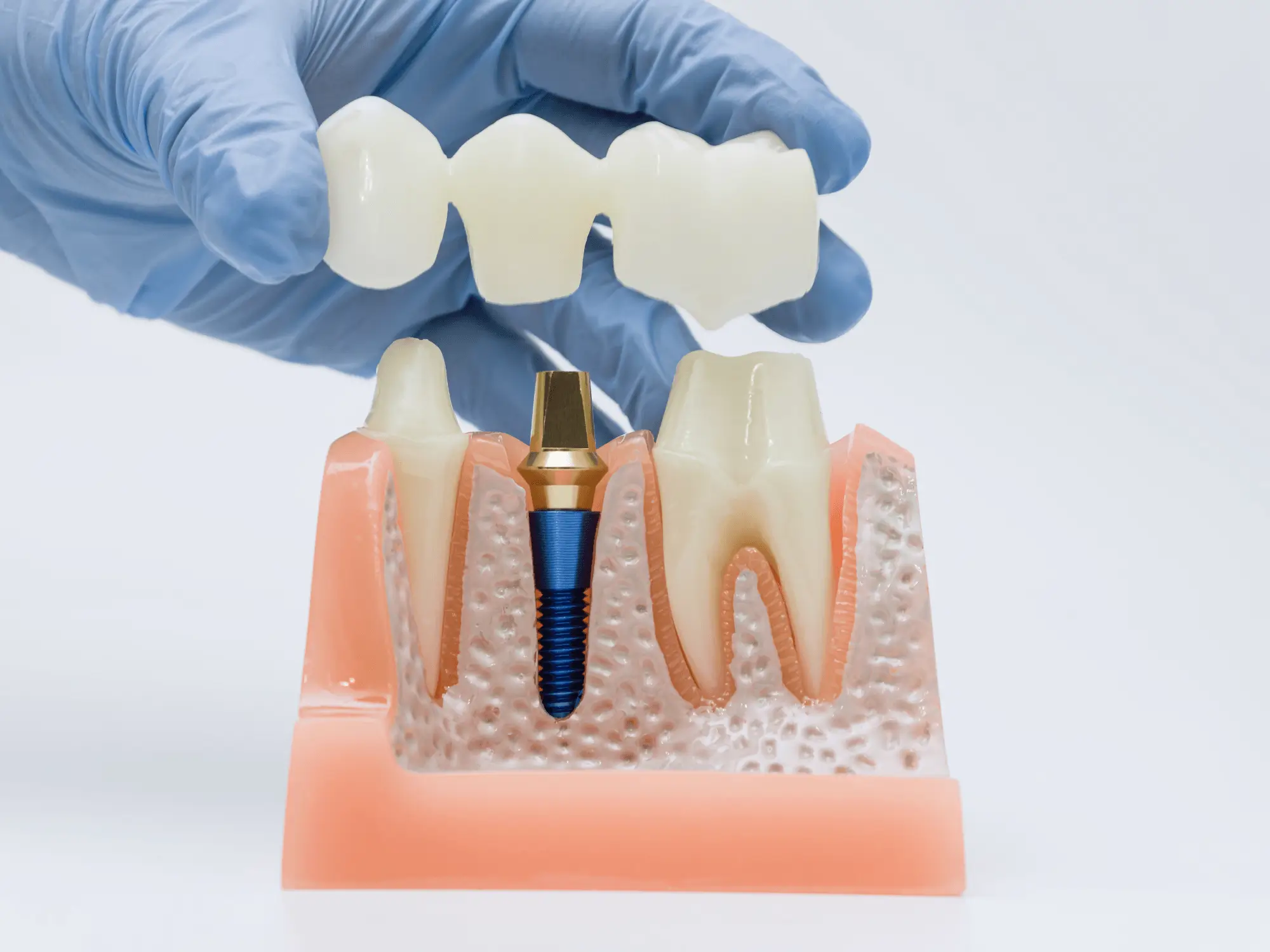 Restaurări Dentare (1)